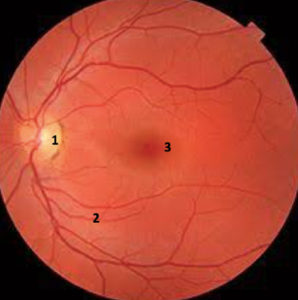 Glaucomul este miopie sau hipermetropie,