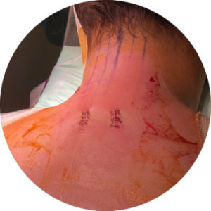 d-trax postoperatorio