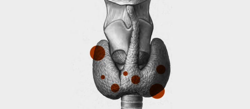 Nódulo de tiroides o nódulo tiroideo