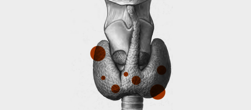 Causas del nódulo en el tiroides
