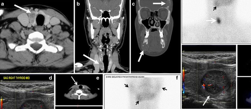 Metástasis del cáncer de tiroides - Linfografía con SPECT-CT