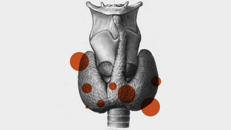 Nódulos de tiroides: qué son, cuándo operar, malignos o benignos
