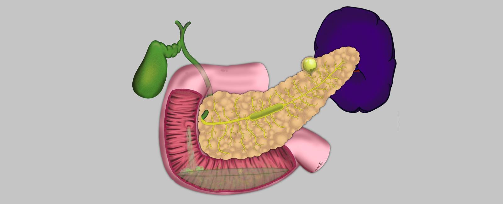 Tumor Papilar Intraductal Mucinoso - TPMI (o IPMN)