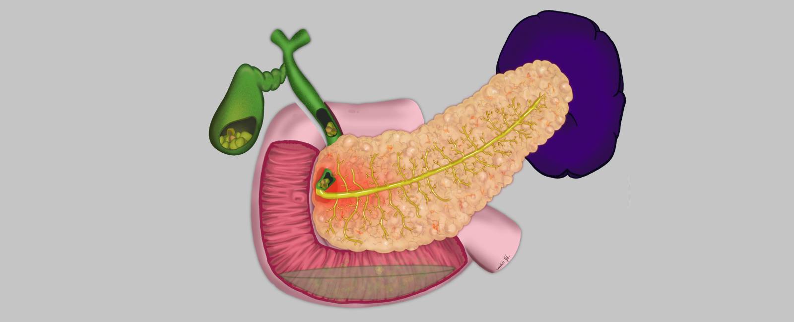 Pancreatitis aguda - Pancreatitis biliar