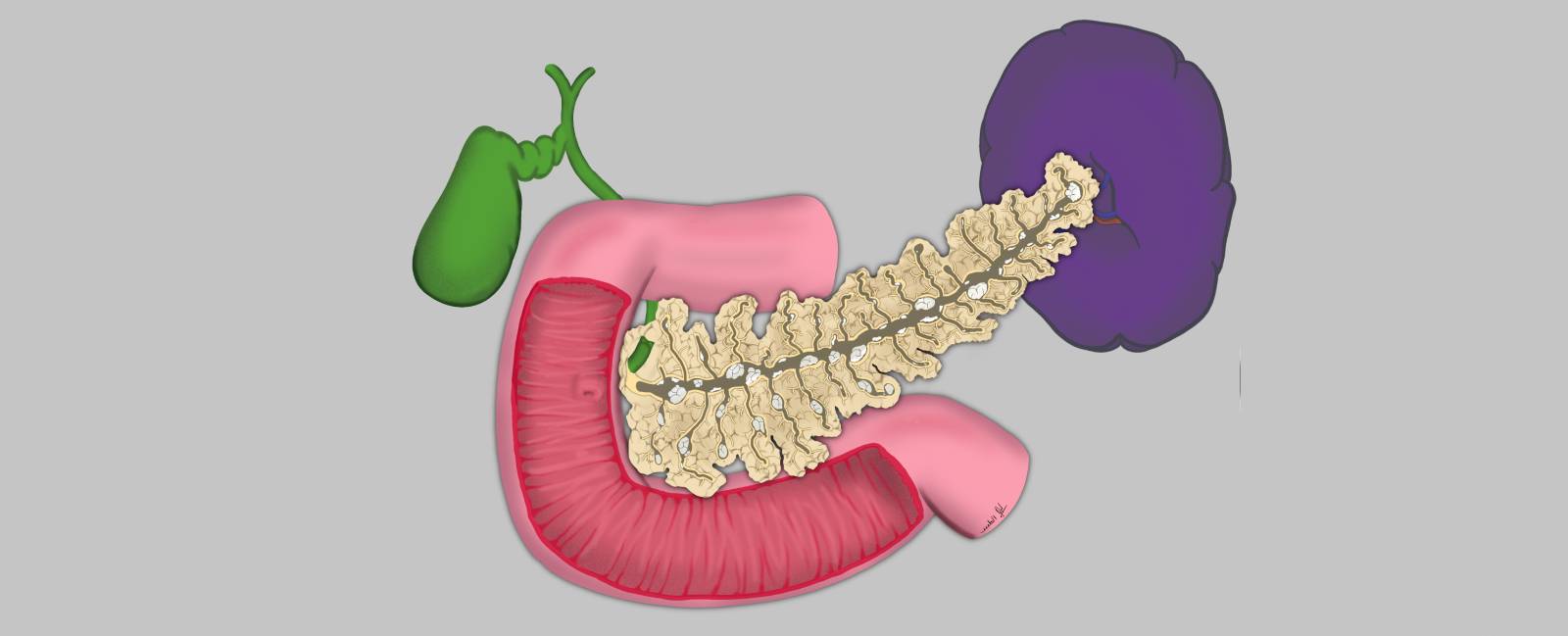 Pancreatitis crónica