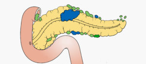 Quiste en el páncreas