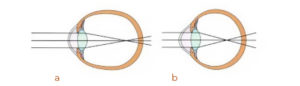 Explicación miopía y glaucoma