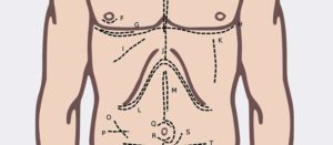 eventració - eventración