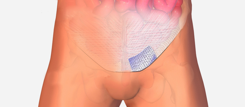 Opciones para la hernia inguinal: La quirúrgica Blog de Patología de la pared abdominal Blog