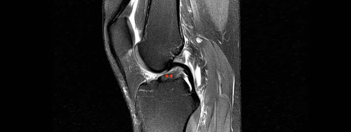Ligamento cruzado roto