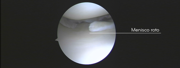 Lesión de menisco roto