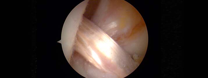 Reconstrucción de ligamento cruzado con isquiotibiales