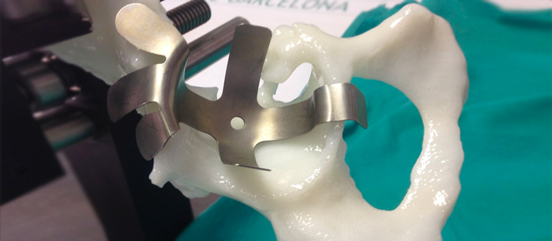 Planificación preoperatoria de prótesis de cadera y rodilla con impresión 3D