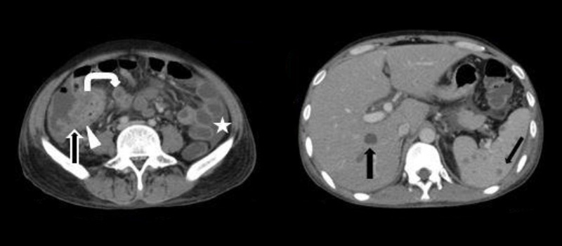 Carcinomatosis Peritoneal - Carcinomatosi Peritoneal - Peritoneal carcinomatosis