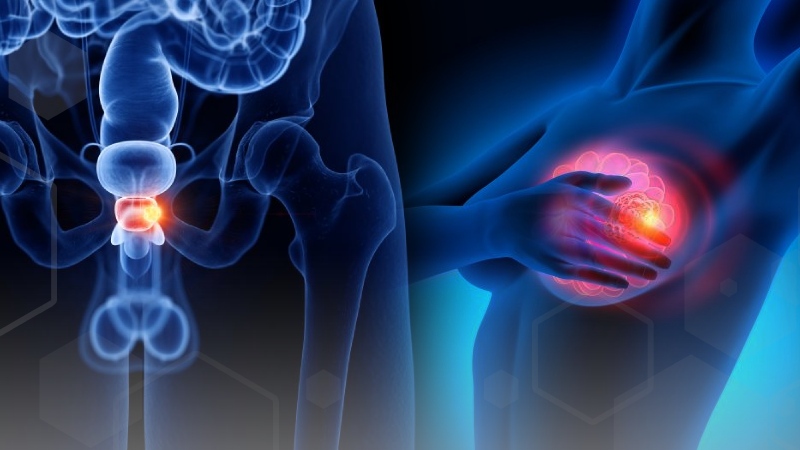 Diagnóstico precoz del cáncer de próstata y de mama