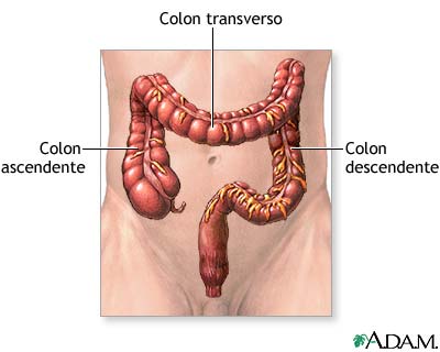 cancer de colon localizado en el ciego