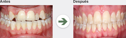 Anterior cross bite, before and after