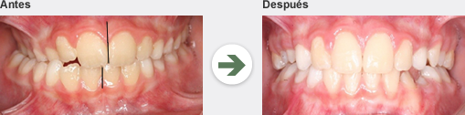 Posterior cross bite, before and after