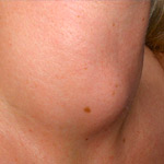 Hipertiroidismo - enfermedades de la tiroides