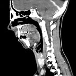 Malformación de Arnold-Chiari