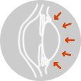 glaucoma secundario