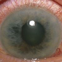 glaucoma - oftalmología