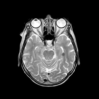 neurooftalmología - oftalmología