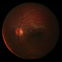 enfermedades de retina - oftalmología