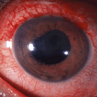 uveitis - oftalmología